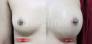 Breast Augmentation
